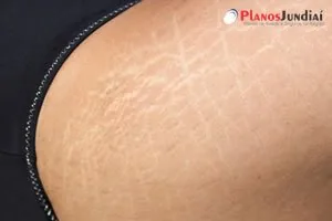 Acabando com celulite nas pernas Acabando com celulite nas pernas