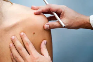 Descubra se o plano de saúde cobre tratamento para Melanoma!
