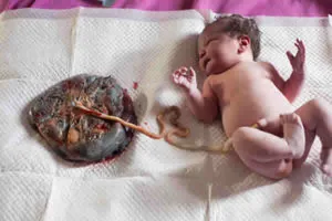 Quais os benefícios de se congelar o cordão umbilical do bebe?